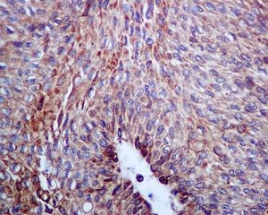 Immunohistochemical analysis of paraffin-embedded Human urinary bladder transitional carcinoma tissue labelling Calumenin with ab137019 at 1/100 dilution.