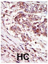 ab37972, at a 1/50 dilution, staining CAMK1G in Human hepatocarcinoma tissue by Immunohistochemistry, Formalin fixed Paraffin embedded tissue. ab37972 was peroxidase-conjugated to the secondary antibody, followed by AEC staining.
