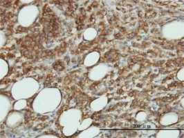 CaMKII beta antibody (ab54926) used in immunohistochemistry at 3ug/ml on formalin fixed and paraffin embedded human malignant lymphoma, diffuse large B tissue.