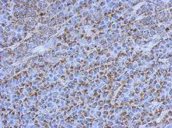 Immunohistochemical analysis of paraffin-embedded HeLa xenograft tissue labeling Cannabinoid Receptor II with ab151414 at 1/500 dilution.