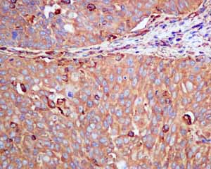 Immunohistochemical analysis of paraffin embedded Human cervical carcinoma tissue using ab155079 showing +ve staining.