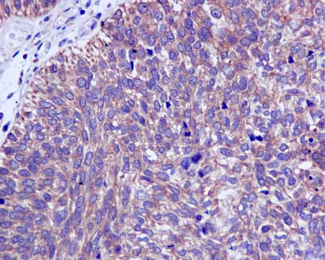 ab166892 showing +ve staining in Human urinary bladder carcinoma.
