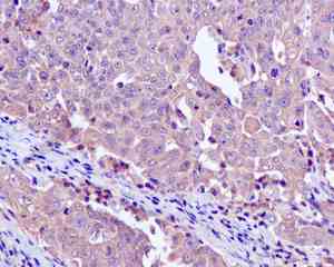 Immunohistochemical analysis of paraffin embedded Human cervical carcinoma tissue labeling CAPZA1 with ab166892 at 1/100 dilution.