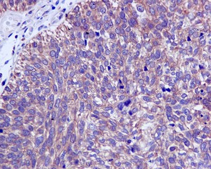 Immunohistochemical analysis of paraffin embedded Human urinary bladder carcinoma tissue labeling CAPZA1 with ab175233 at 1/100.