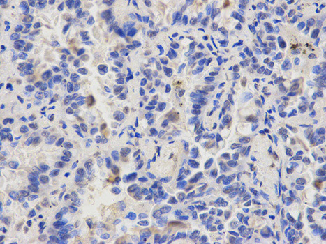 Immunohistochemistry (Formalin/PFA-fixed paraffin-embedded sections) analysis of human lung cancer tissue labelling CAPZA2 with ab175378 at 1/200. Magnification: 400x.