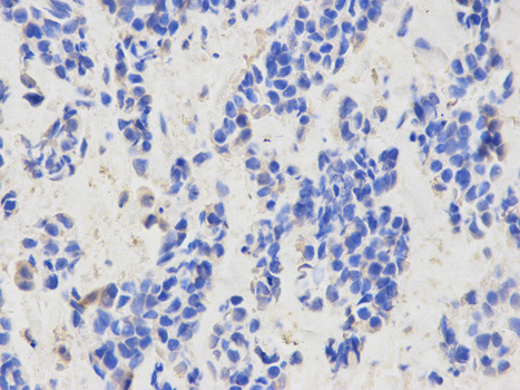 Immunohistochemistry (Formalin/PFA-fixed paraffin-embedded sections) analysis of human breast cancer tissue labelling CAPZA2 with ab175378 at 1/200. Magnification: 400x.