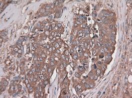 ab84999 staining Carboxypeptidase A in paraffin-embedded Adenocarcinoma of breast by immunohistochemistry.
