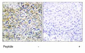 Immunohistochemistry analysis of paraffin-embedded human liver carcinoma tissue using ab69920 at 1/50 dilution, in the presence and absence of immunising peptide.