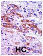 Formalin-fixed and paraffin-embedded human cancer tissue reacted with ab37971, which was peroxidase-conjugated to the secondary antibody, followed by AEC staining. HC = hepatocarcinoma.