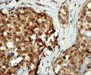 Immunohistochemical analysis of Casein Kinase 2 beta in paraffin embedded human ovary carcinoma tissue using ab76025 at a 1/100 dilution.