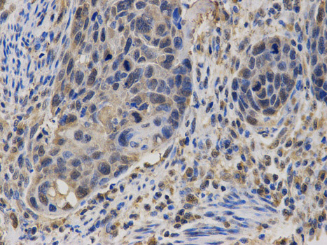 Immunohistochemistry (Formalin/PFA-fixed paraffin-embedded sections) analysis of human esophageal cancer tissue labelling CASK with ab185932 at 1/100. Magnification: 400x.