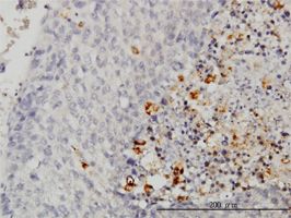 Caspase-1 antibody (ab54932) used in immunohistochemistry at 3ug/ml on formalin fixed and paraffin embedded human hepatocellular carcinoma.