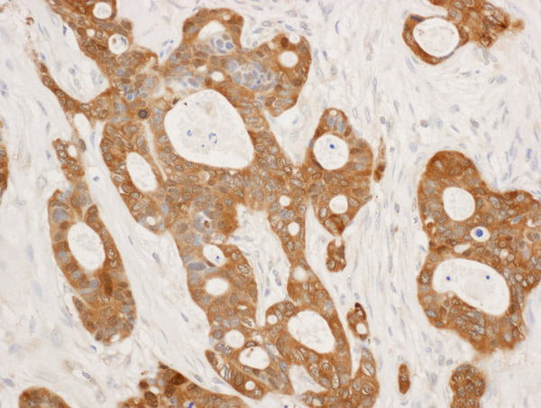 Immunohistochemistry (Formalin/PFA-fixed paraffin-embedded sections) analysis of human ovarian carcinoma tissue labelling 14-3-3 sigma with ab86380 at 1/1000 (1µg/ml). Detection: DAB.