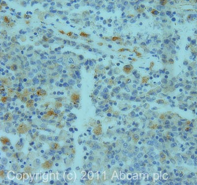 IHC image of ab24508 staining in human colon carcinoma formalin fixed paraffin embedded tissue section, performed on a Leica BondTM system using the standard protocol F. The section was pre-treated using heat mediated antigen retrieval with sodium citrate buffer (pH6, epitope retrieval solution 1) for 20 mins. The section was then incubated with ab24508, 1µg/ml, for 15 mins at room temperature and detected using an HRP conjugated compact polymer system. DAB was used as the chromogen. The section was then counterstained with haematoxylin and mounted with DPX.For other IHC staining systems (automated and non-automated) customers should optimize variable parameters such as antigen retrieval conditions, primary antibody concentration and antibody incubation times.
