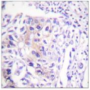 ab58505 at a 1/50 dilution staining CBL (phosphorylated at tyrosine 774) in Human breast carcinoma tissue. 