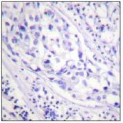 ab58505, at a 1/50 dilution, plus immunising peptide, staining CBL (phosphorylated at tyrosine 774) in Human breast carcinoma tissue.