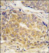 ab75946, at a dilution of 1/10, staining CBR1 in formalin fixed, paraffin embedded human breast carcinoma tissue by Immunohistochemistry. ab75946 was peroxidase conjugated to the secondary antibody, followed by DAB staining.