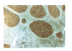 Immunohistochemical analysis of Caspase 3 expression in formalin fixed, paraffin embedded human reactive lymph node using ab47131 at 1/2000. Staining is seen in the apoptosis prone germinal center B lymphocytes of follicles. In constrast little or no staining is seen in the surrounding long live mantle zone lymphocytes.