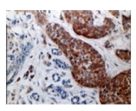 Immunohistochemical analysis of Caspase 3 expression in formalin fixed, paraffin embedded human breast ductal carcinoma in situ using ab47131 at 1/2000. Staining is seen in the the cancerous ducts, but not in the normal lobulus.