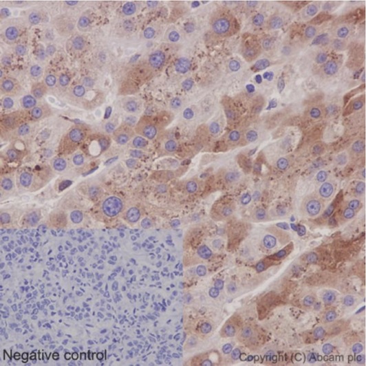 Immunohistochemical analysis of paraffin-embedded Human hepatocellular carcinoma tissue labeling CCN3 with ab191425 at 1/100 dilution followed by pre-diluted HRP Polymer for Rabbit IgG secondary antibody and counter-stained with Hematoxylin. Inset: Negative control: using PBS instead of primary antibody.