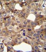 Immunohistochemistry (Formalin/PFA-fixed paraffin-embedded sections) analysis of human breast carcinoma tissue labelling CCNI2 with ab170531. A peroxidase-conjugated anti-rabbit IgG was used as the secondary antibody, followed by DAB staining.