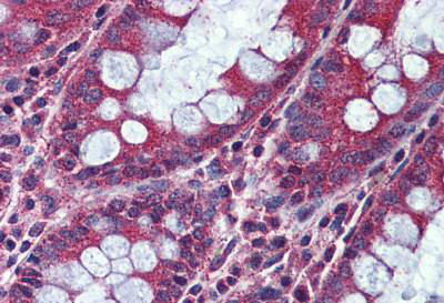 Immunohistochemical analysis of formalin-fixed, paraffin-embedded Human colon tissue labelling Activin A Receptor Type IC with ab140705 at 5 µg/ml.
