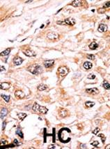 ab60157, at a 1/50-1/100 dilution, staining Activin Receptor Type IA in human hepatocarcinoma on Formalin fixed Paraffin embedded tissue. A peroxidase-conjugated secondary antibody was used, followed by AEC staining.