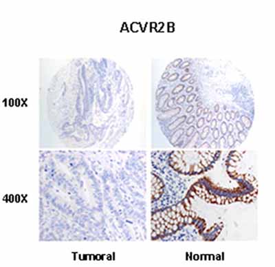 ACVR2B staining was mainly localized at the membrane level of the epithelial cells in the normal tissues with a clear down-regulation in tumoral epithelia.