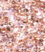 Immunohistochemical analysis of formalin fixed, paraffin embedded Human hepatocarcinoma tissue labelling Activin Receptor Type IIB with ab135635 at 1/50 dilution. Immunohistochemistry followed by peroxidase conjugation of the secondary antibody and AEC staining.