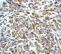 ab75769 at 1/250 dilution staining CD146 in melanoma tissue, using a HRP/AP polymerized secondary antibody.