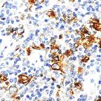 ab53997, at a dilution of 1/50, staining CD15 in formalin fixed paraffin embedded Hodgkin’s lymphoma tissue sections by Immunohistochemistry.