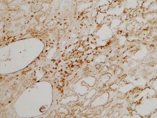 This immunoperoxidase picture shows inflammatory cell infiltration with many T-lymphocytes in the interstitium of human kidneys with congenital nephrotic syndrome of the Finnish type (CNF, NPHS1). Immunoperoxidase staining of frozen sections with ab828 antibody (oval shaped, unstained spaces on the left are glomeruli).This image was kindly supplied as part of the review submitted by Arvi-Matti-Kuusniemi.