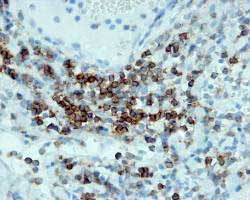 Ab828 positively staining formaldehyde fixed human tonsil tissue at 1/50 in conjunction with goat anti rabbit HRP. Detection by DAB.Pressure cooker heat mediated antigen retrieval was employed in citrate buffer pH 6.0.This image is courtesy of an Abreview submitted by Melanie Black on 22 Aug 05. We do not have any further information relating to this image.