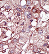 ab37807 at a 1/50 dilution detecting ACVRL1 expression in human hepatocarcinoma tissue (a peroxidase-conjugated secondary antibody, followed by AEC staining was used). These data demonstrate the suitability of this antibody for immunohistochemistry; clinical relevance has not been evaluated.