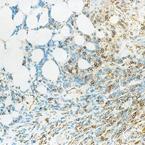 Paraffin section of human lymph node, B cell lymphoma: immunohistochemical staining for CD39 antigen using ab49580. Note intense membrane staining of tumor cells.