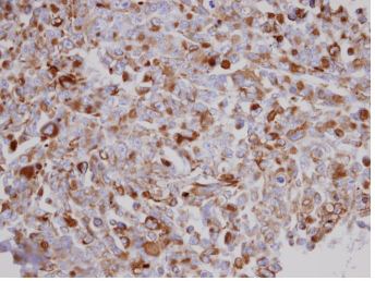 ab137616 at 1/100 dilution, staining Acylglycerol Kinase in paraffin embedded H1299 xenograft tissue by Immunohistochemistry.