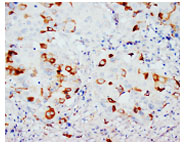 ab65854, at 2µg/ml, staining CD40L in the cytoplasm of paraffin embedded mammary cancer tissue by Immunohistochemistry. DAB chromogenic reaction.