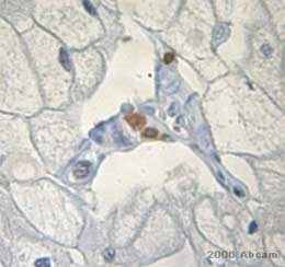 ab6632 at 1/10 dilution staining human Renal Carcinoma tissue sections by Immunohistochemistry (Formalin-fixed paraffin-embedded sections). Folowing heat mediated antigen retrieval the tissue was stained with antibody for 12 hours and then detected using a biotinylated donkey anti-mouse IgG antibody.This image is courtesy of an Abreview submitted on 3 March 2006.See Abreview