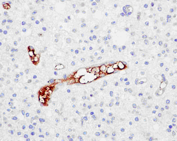 Immunohistochemical analysis of paraffin-embedded Human gliocytoma tissue labeling CD62P with ab182135 at 1/500 dilution followed by pre-diluted HRP-conjugated secondary antibody and counter-stained with Hematoxylin.