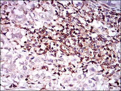 Immunohistochemical analysis of paraffin-embedded Human bladder cancer tissue labeling CD68 with ab201973 at 1/200 dilution followed by DAB staining.