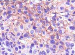 ab91086, at 1/200 dilution, staining CD73 in paraffin-embedded Human cholangiocarcinorna tissue by Immunohistochemistry using DAB staining.