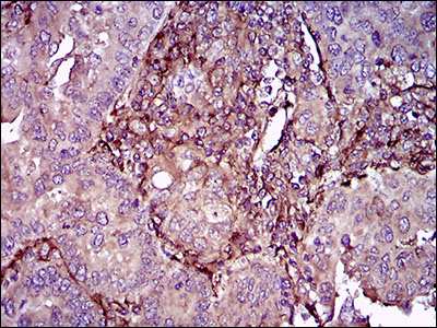 Immunohistochemical analysis of paraffin-embedded Human endometrial cancer tissue labeling CD90 / Thy1 with ab181469 at 1/200 dilution with DAB staining.