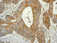 ab108368 at 1/250 dilution staining CD97 in Human colonic adenocarcinoma by Immunohistochemistry, Paraffin-embedded tissue.