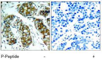 ab75743, at a 1/50 dilution, staining Cdc25A in paraffin embedded human breast carcinoma tissue by Immunohistochemistry, in the absence (left image) or presence (right image) of the immunizing phospho peptide.