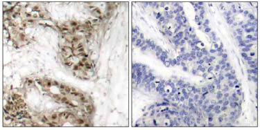 ab47322 staining human breast carcinoma tissue by IHC-P (left hand panel). The right hand panel shows staining in the presence of phospho-peptide. 