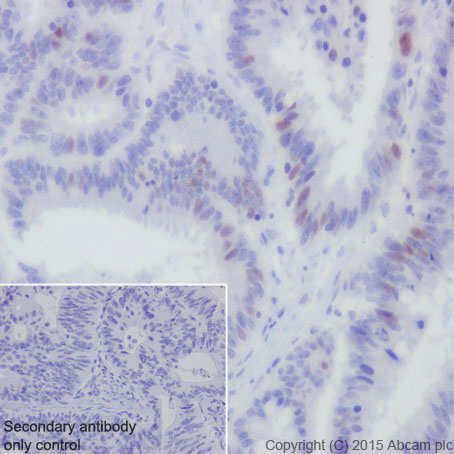 Immunohistochemical analysis of paraffin-embedded Human colonic carcinoma tissue labeling CDT1 with ab202067 at 1/100 dilution, followed by Goat Anti-Rabbit IgG H&L (HRP) (ab97051) secondary antibody at 1/500 dilution.Nuclear staining on Human colonic carcinoma tissue is observed.Counter stained with Hematoxylin.Secondary antibody only control: Used PBS instead of primary antibody, secondary antibody is Goat Anti-Rabbit IgG H&L (HRP) (ab97051) at 1/500 dilution.