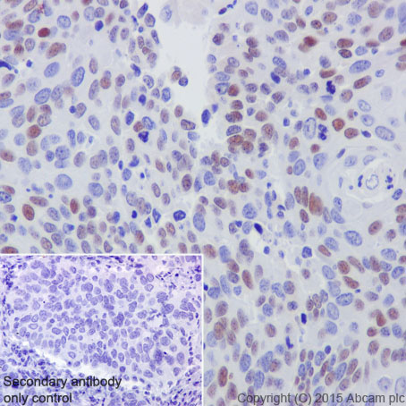 Immunohistochemical analysis of paraffin-embedded Human cervix carcinoma tissue labeling CDT1 with ab202067 at 1/100 dilution, followed by Goat Anti-Rabbit IgG H&L (HRP) (ab97051) secondary antibody at 1/500 dilution. Nuclear staining on Human cervix carcinoma tissue is observed.Counter stained with Hematoxylin.Secondary antibody only control: Used PBS instead of primary antibody, secondary antibody is Goat Anti-Rabbit IgG H&L (HRP) (ab97051) at 1/500 dilution.