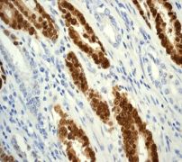 ab76541, at 1/250 dilution, staining CDX2 in paraffin-embedded human gastric adenocarcinoma tissue, by immunohistochemistry.