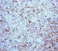 ab113076 at 1/500 dilution, staining CEND1 in Praffin-embedded Human glioma tissue by Immunohistochemistry.