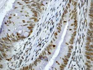 ab45694 showing positive staining in Colonic adenocarcinoma tissue.